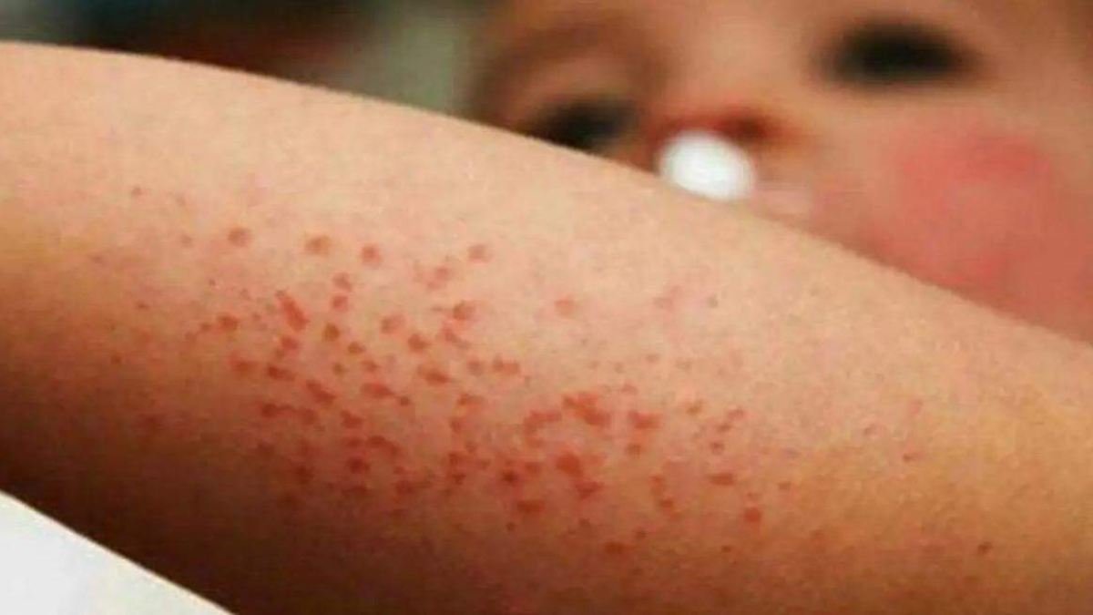 Confirman muerte de niño por sarampión en Durango: Secretaría de Salud