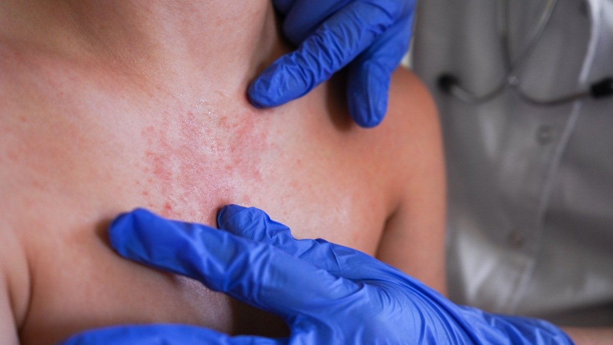 Mezquital y Durango concentran la mayoría de casos de sarampión en el estado